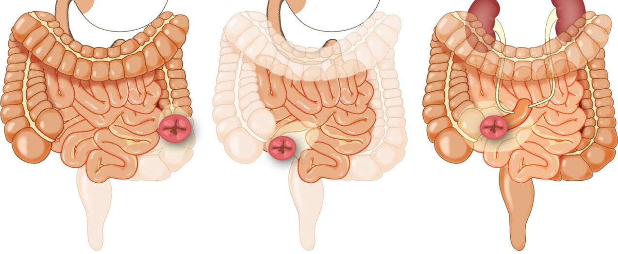 Stoma torbası değişim adımları ve gerekli malzemeler